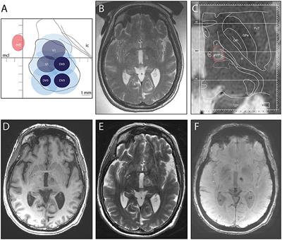 Bilateral MR-Guided Focused Ultrasound Pallidothalamic Tractotomy for Parkinson's Disease With 1-Year Follow-Up